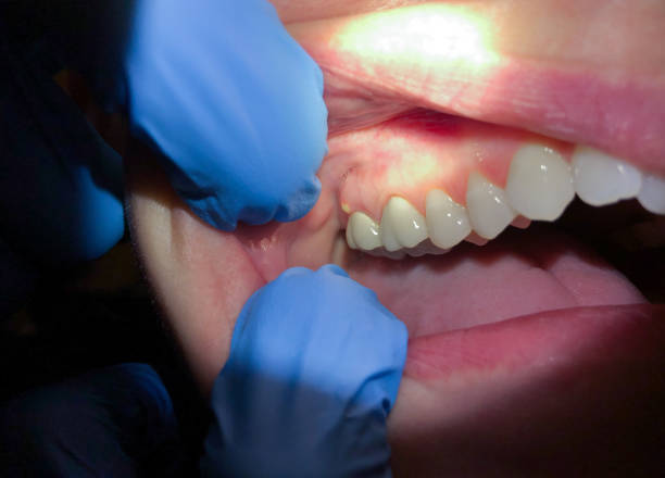 Best Emergency Wisdom Tooth Extraction in Bruce, MS